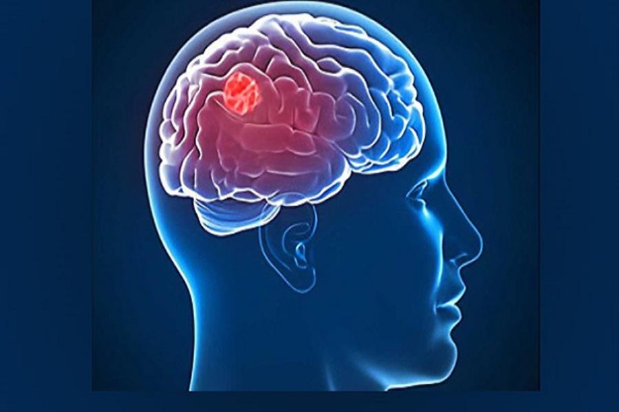 درمان سرطان مغزی با استفاده از فناوری پلاسما